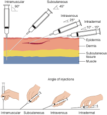 Intramuscular injection